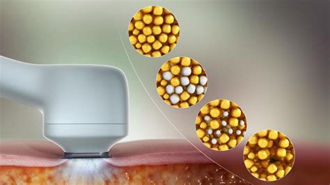 Cryolipolysis: The future of cryolipolysis .